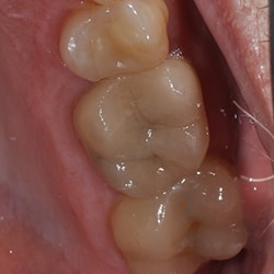 After Picture of Cerec Work on Teeth