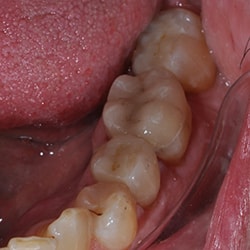After Picture of Cerec Work