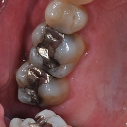 Before Picture of Cerec Work on Teeth