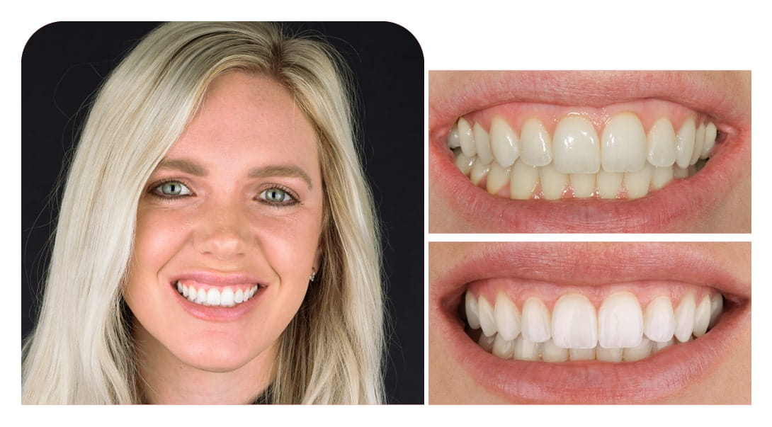 Invisalign Before Afters Invisalign No Braces Smile 